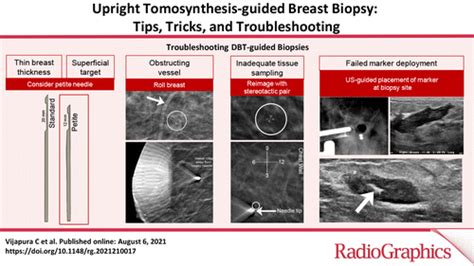 Stereotactic Biopsy