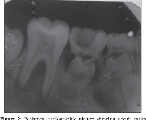 Figure 2 From Management Of Occult Caries Induced Large Periapical