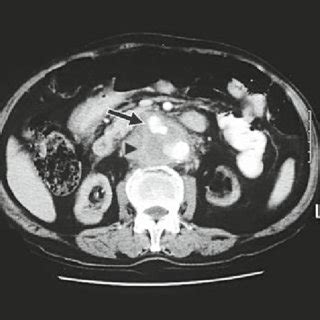 Preoperative Abdominal Computed Tomography Ct Scan With Contrast