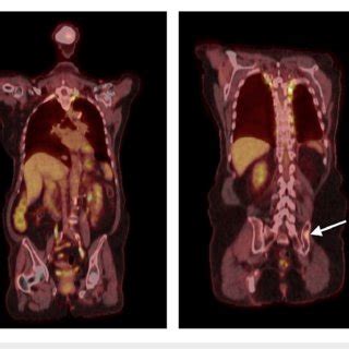 PET-CT scan from June 2020 Left: PET-CT scan from June 2020 following ...