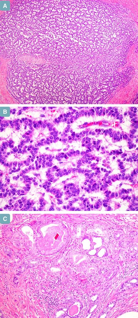 Well Differentiated Neuroendocrine Tumor Net Well Differentiated Net Download Scientific