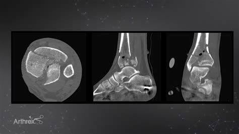 Arthrex Pilon Fracture With Anterolateral And Posterior Distal Tibia