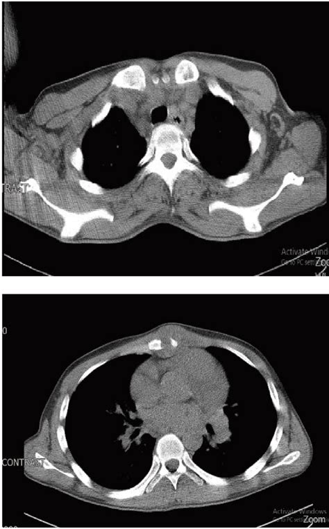 Chest CT Scan with and without contrast (February 2018): Mediastinal ...