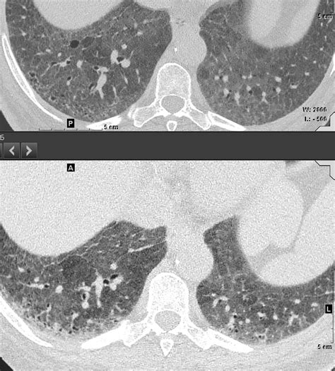 Faces of Mosaic Attenuation | Lungs