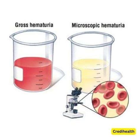 Blood in Urine (Hematuria Gross): Causes & Treatments | Credihealth