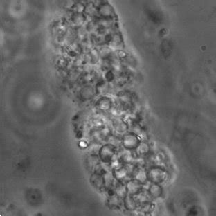 A renal tubular epithelial cell containing cast. Please note the renal ...