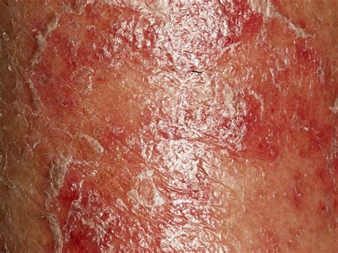 Skin Pathology Commonly Associated With HIV Infection