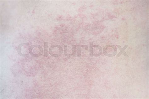 Close up Allergy rash on a man skin | Stock image | Colourbox