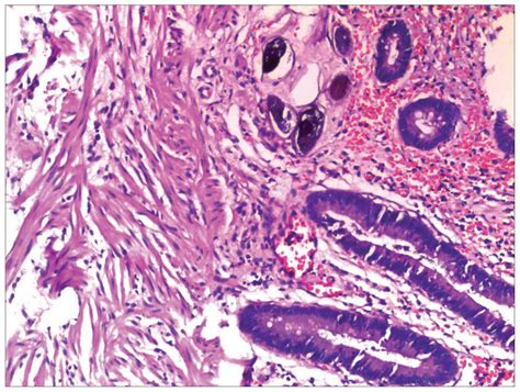 Endoscopic Characteristics And Causes Of Misdiagnosis Of Intestinal Schistosomiasis