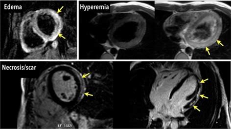 Diagnostics Free Full Text Cardiac Mri And Myocardial Injury In