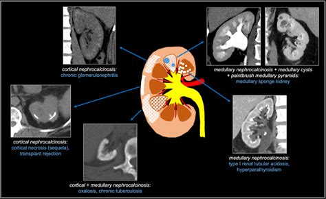 of calcific diffuse renal diseases | Download Scientific Diagram