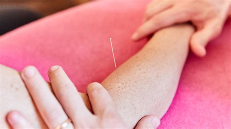 Things You Didn T Know About Acupuncture And Dry Needling