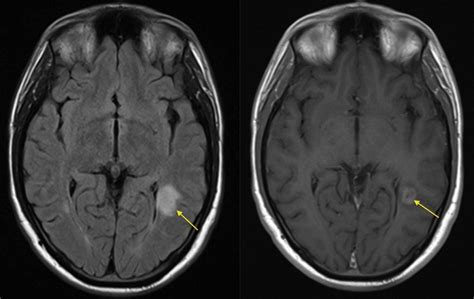 Multiple Sclerosis Enhancing Plaque Radiology At St Vincents University Hospital