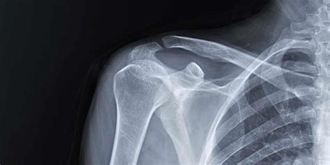 X Ray To Diagnose Shoulder Dislocation Pristyn Care