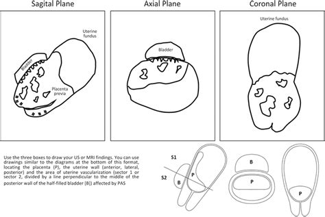 Figure 1 From Placenta Accreta Spectrum Prenatal Diagnosis Performance