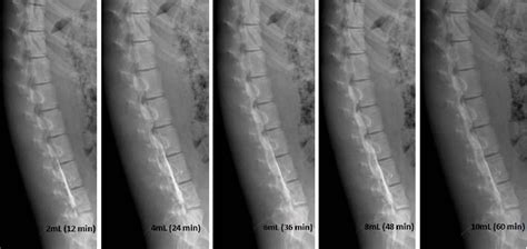 Bolus Epidural Infusion Improves Spread Compared With Continuous