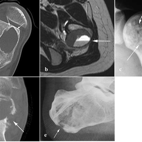 Histology Of Chondroblastoma He Staining A Pink Cartilage B