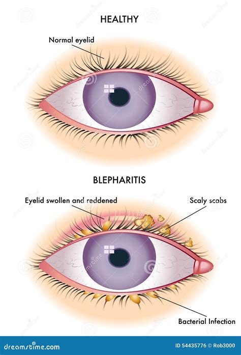 Blepharitis Stock Photo - Image: 54435776