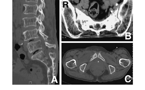 Case 1 Preoperative Computed Tomography Scans Revealing S3 Sacral Body