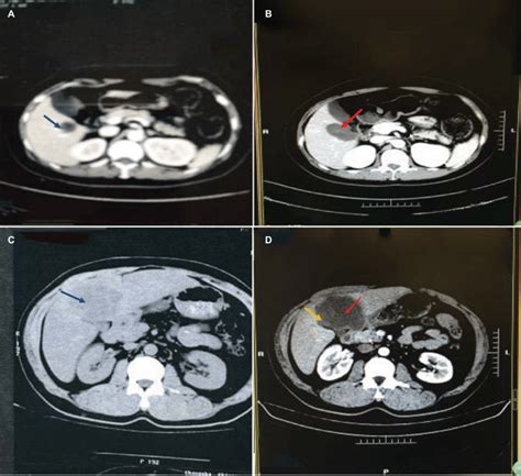 Partial And Complete Ablation Notes A Sigmoid Colon Cancer