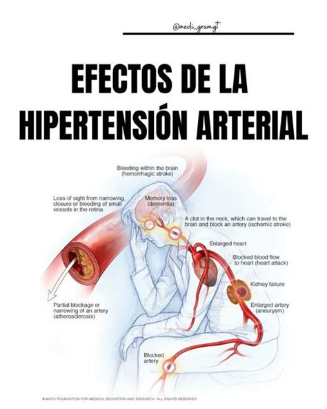 Efectos de la hipertensión arterial medi fer uDocz