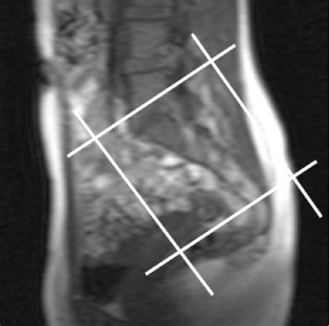 Figure From Mri Findings Of Active And Chronic Sacroiliitis In Light