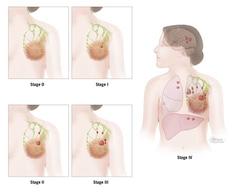 Staging And Grade Breast Pathology Johns Hopkins Pathology