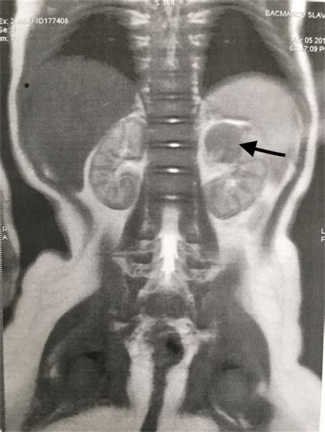 Mri Coronal View Arrow Show Tumor Mass On The Upper Pole Of The Left