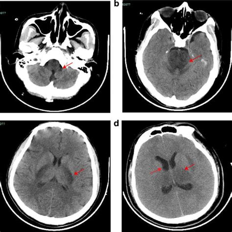 Abnormal Head Ct Imaging Head Ct Appearance Of The Medulla Oblongata Download Scientific