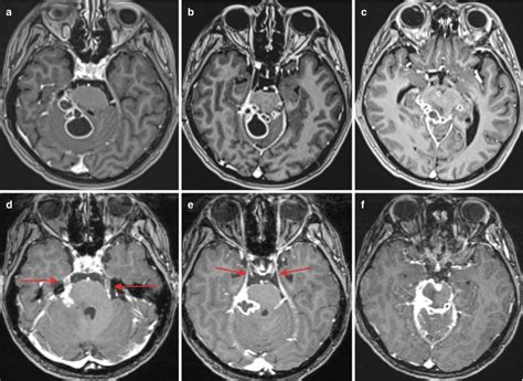 Fig 65 Proven Tuberculous Meningitis With Multiple Diseases Of The Brain Head And