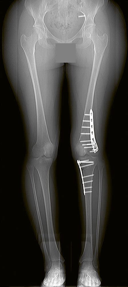 Knieschmerz Instabilität der Patella und Arthrose ATOS NEWS