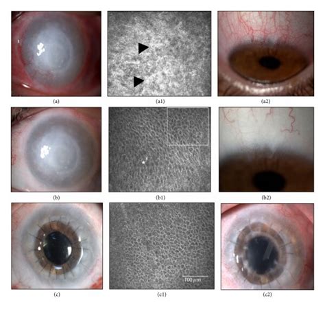 Case 11 Table 1 Before And After Cultivated Limbal Epithelial Download Scientific Diagram