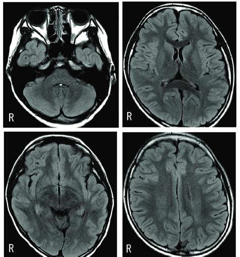 Cephalic MRI MRI showing no structural abnormality. | Download ...