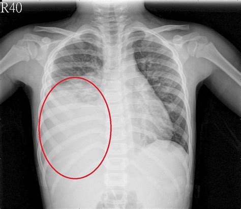 Symptoms Of Mycoplasma Pneumonia