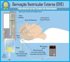 Deriva O Ventricular Externa Dve Enfermagem Ilustrada Enfermagem