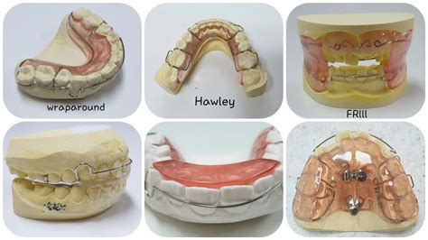 Removable Appliances Fixed Appliances Orthodontic Appliances Retainer