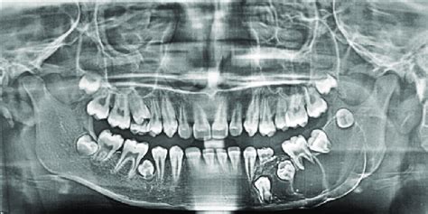 Preoperative Radiograph Orthopantomogram Showing The Multilocular