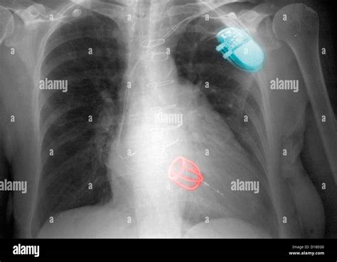 Mitral Valve Replacement Chest X Ray