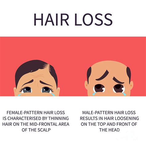 Hair Loss In Men And Women Photograph By Art4stockscience Photo