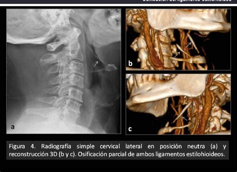 Figure 1 From Calcificación Sintomática Del Ligamento Estilohioideo