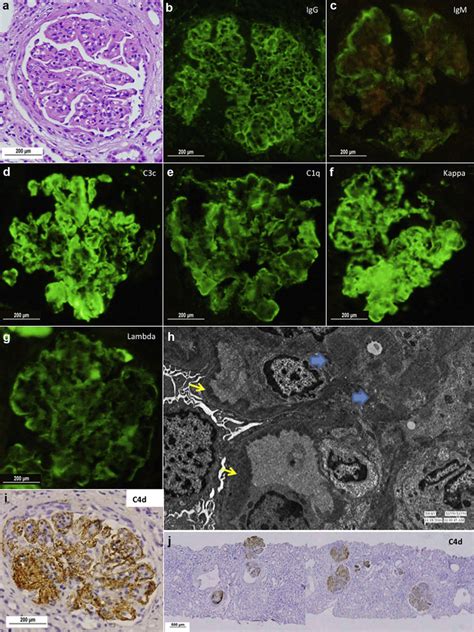 A Representative Case Of Immune Complex Mediated Membranoproliferative Download Scientific