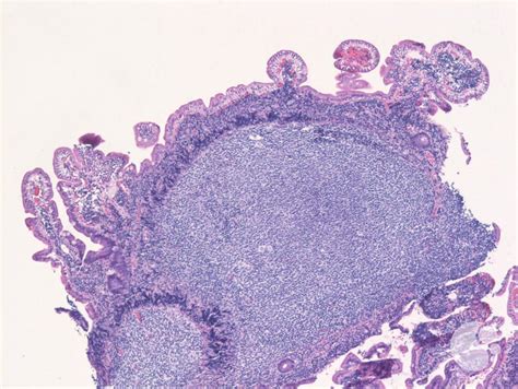 Duodenal Type Follicular Lymphoma