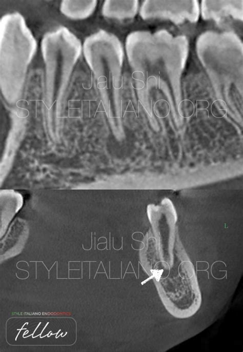 Dens Evaginatus - A case report - Style Italiano Endodontics