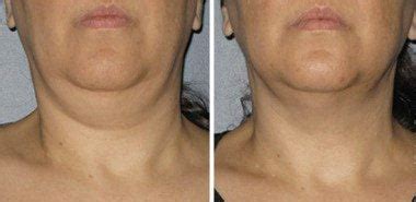 Ultherapy Before After Fairfax Va Impressions Medspa