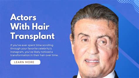 Actors With Hair Transplant: 8 Celebrities Before&After