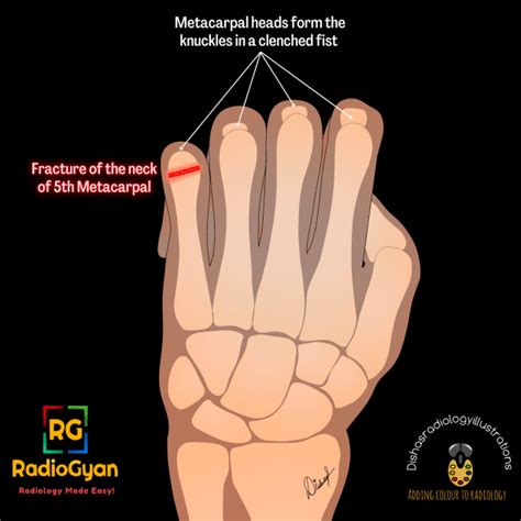 Boxer’s Fracture [Why is it A Misnomer?] | Radiology Case | - RadioGyan