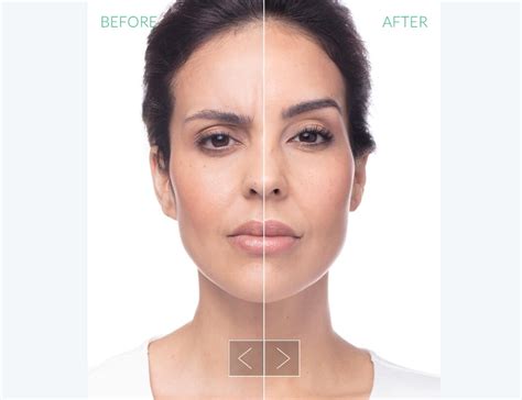 Unlock Youthful Radiance With Neuromodulator Injections — Skin Medex