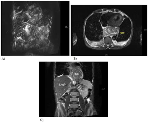 Figure 6 Magnetic Resonance Cholangiopancreatography MRCP