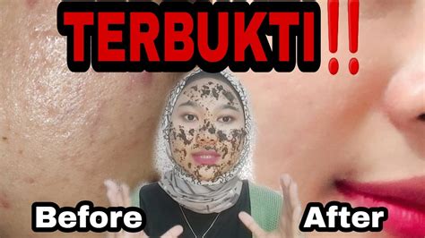 Terbukti Cara Menghilangkan Jerawat Dan Bekasnya Secara Permanen Youtube