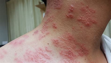 Shingles Rash On Neck